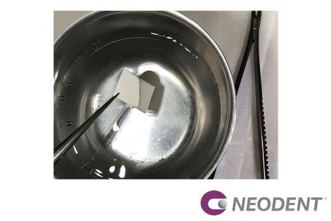 Reanatomização de Componente + Enxerto com Straumann® Mucoderm® para Solucionar Retração Gengival