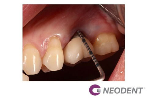 Reanatomização de Componente + Enxerto com Straumann® Mucoderm® para Solucionar Retração Gengival