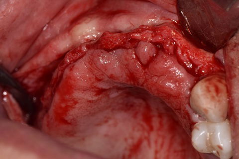 Visão Oclusal Incisão