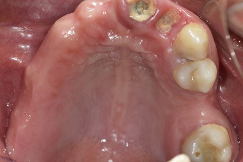 Visão Oclusal Pré-Cirúrgica