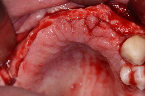 Visão Oclusal do Rebordo Regularizado