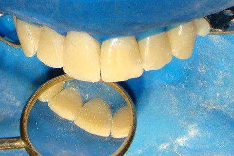 Avaliação pela palatina e vestibular; visão em 3D para observar inclinações