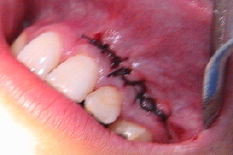 Exodontia de Caninio Incluso em Maxila - Acesso Vestibular