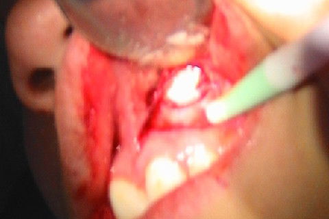 Exodontia de Caninio Incluso em Maxila - Acesso Vestibular