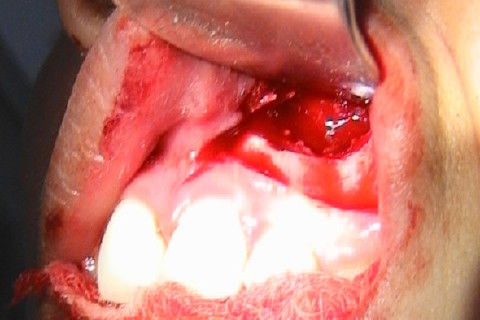 Exodontia de Caninio Incluso em Maxila - Acesso Vestibular