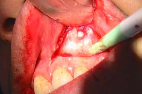 Exodontia de Caninio Incluso em Maxila - Acesso Vestibular