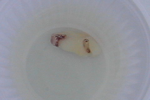 Exodontia de Caninio Incluso em Maxila - Acesso Vestibular