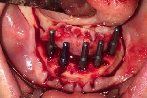 Prótese Protocolo Imediata Inferior com Carga Imediata