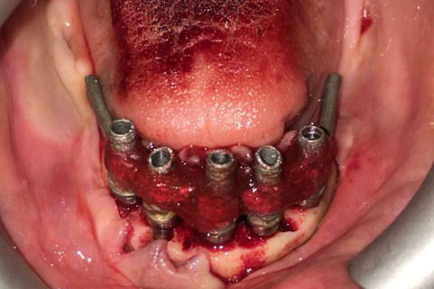 Prótese Protocolo Imediata Inferior com Carga Imediata
