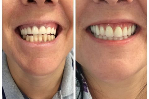 Prótese Protocolo Imediata Inferior com Carga Imediata