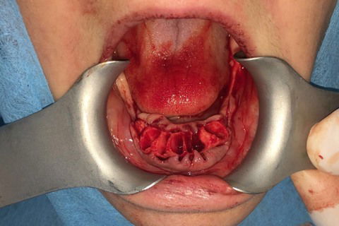 Prótese Protocolo Imediata Inferior com Carga Imediata