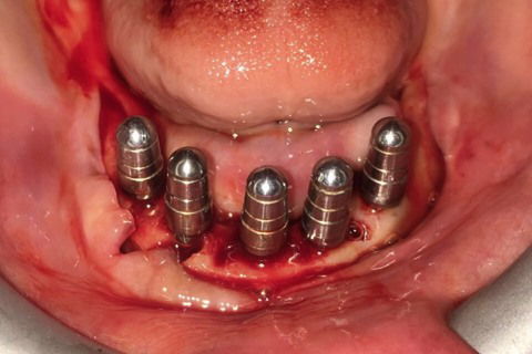 Prótese Protocolo Imediata Inferior com Carga Imediata