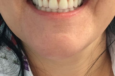 Prótese Protocolo Imediata Inferior com Carga Imediata