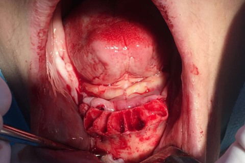 Prótese Protocolo Imediata Inferior com Carga Imediata