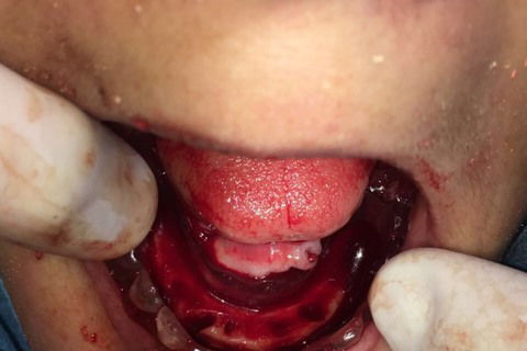 Prótese Protocolo Imediata Inferior com Carga Imediata