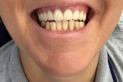 Prótese Protocolo Imediata Inferior com Carga Imediata