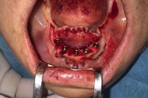 Prótese Protocolo Imediata Inferior com Carga Imediata