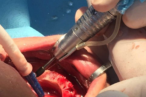 Prótese Protocolo Imediata Inferior com Carga Imediata