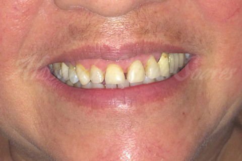 Situação da saúde periodontal após 2 meses