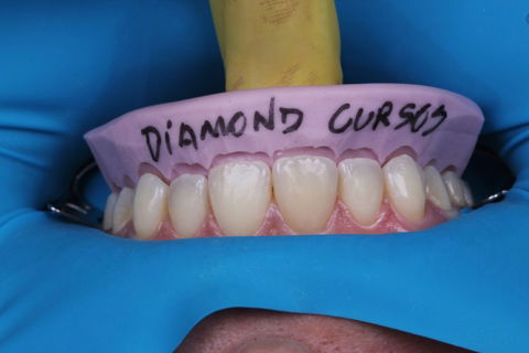 Estratificação em Resina Composta com Empress Direct - Ivoclar