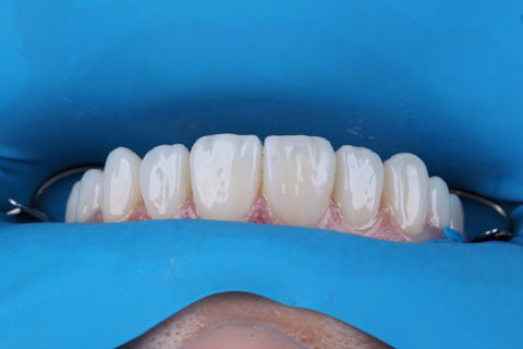 Estratificação em Resina Composta com Empress Direct - Ivoclar