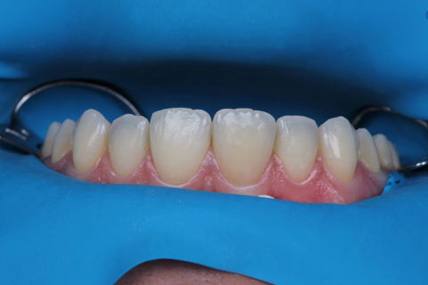 Estratificação em Resina Composta com Empress Direct - Ivoclar