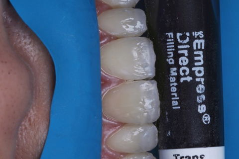 Estratificação em Resina Composta com Empress Direct - Ivoclar