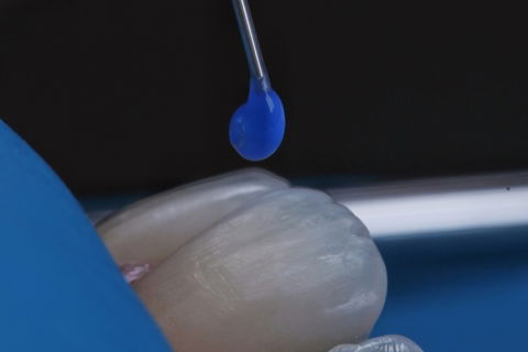 Estratificação em Resina Composta com Empress Direct - Ivoclar