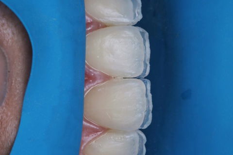 Estratificação em Resina Composta com Empress Direct - Ivoclar