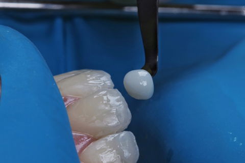 Estratificação em Resina Composta com Empress Direct - Ivoclar