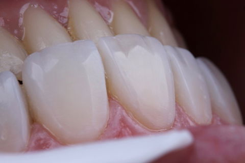 Estratificação em Resina Composta com Empress Direct - Ivoclar