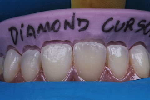 Estratificação em Resina Composta com Empress Direct - Ivoclar