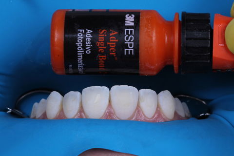 Estratificação em Resina Composta com Empress Direct - Ivoclar