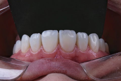 Estratificação em Resina Composta com Empress Direct - Ivoclar