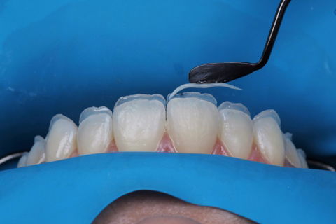 Estratificação em Resina Composta com Empress Direct - Ivoclar