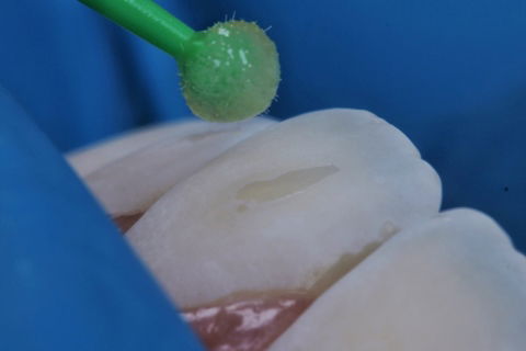 Estratificação em Resina Composta com Empress Direct - Ivoclar