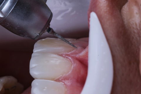 Estratificação em Resina Composta com Empress Direct - Ivoclar