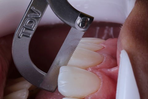 Estratificação em Resina Composta com Empress Direct - Ivoclar