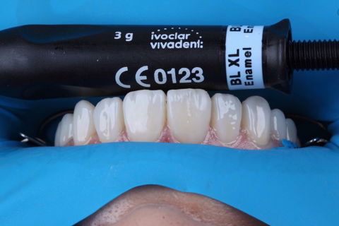 Estratificação em Resina Composta com Empress Direct - Ivoclar