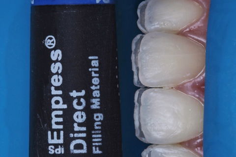 Estratificação em Resina Composta com Empress Direct - Ivoclar