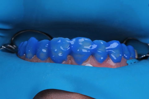 Estratificação em Resina Composta com Empress Direct - Ivoclar