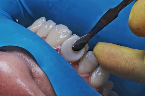 Estratificação em Resina Composta com Empress Direct - Ivoclar