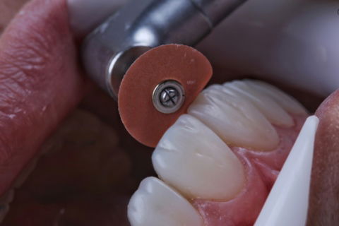 Estratificação em Resina Composta com Empress Direct - Ivoclar