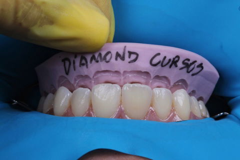 Estratificação em Resina Composta com Empress Direct - Ivoclar