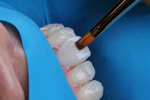 Estratificação em Resina Composta com Empress Direct - Ivoclar