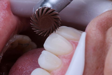 Estratificação em Resina Composta com Empress Direct - Ivoclar