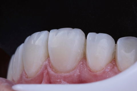 Estratificação em Resina Composta com Empress Direct - Ivoclar