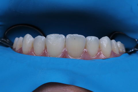 Estratificação em Resina Composta com Empress Direct - Ivoclar