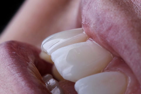 Estratificação em Resina Composta com Empress Direct - Ivoclar