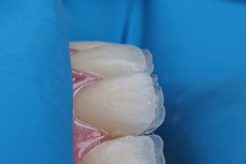 Estratificação em Resina Composta com Empress Direct - Ivoclar